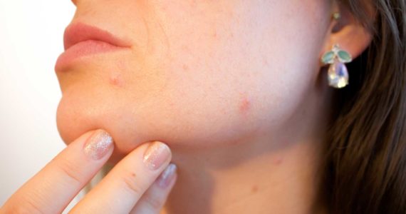 pickel-bekämpfen-10-natürliche-Tipps-gegen-Mitesser-&-Pickel