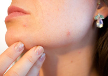 Hausmittel gegen Hautunreinheiten