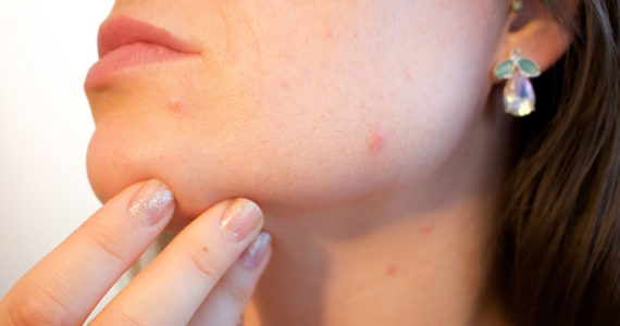 Hausmittel gegen Hautunreinheiten